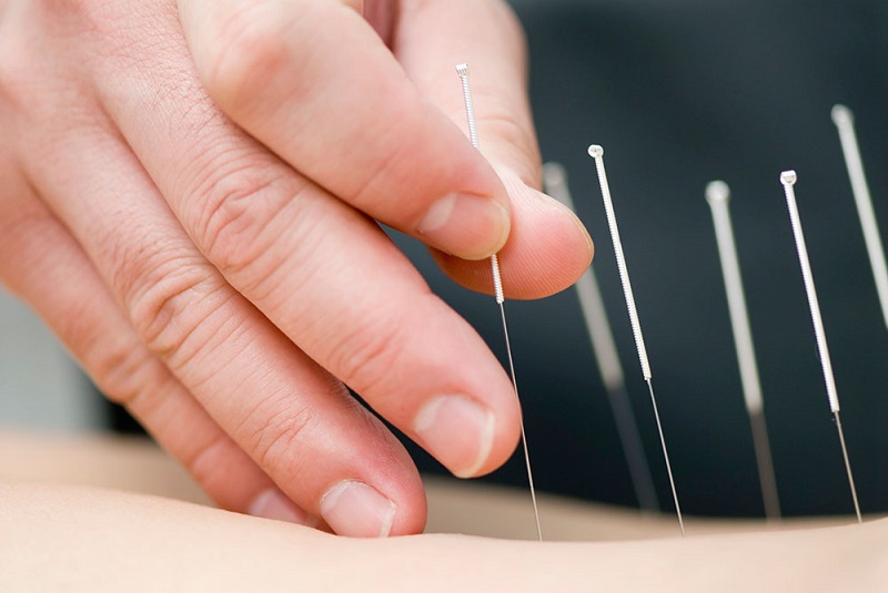 What is the acupuncture What are the techniques of acupuncture